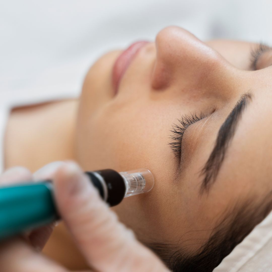 Benefits Of Microneedling