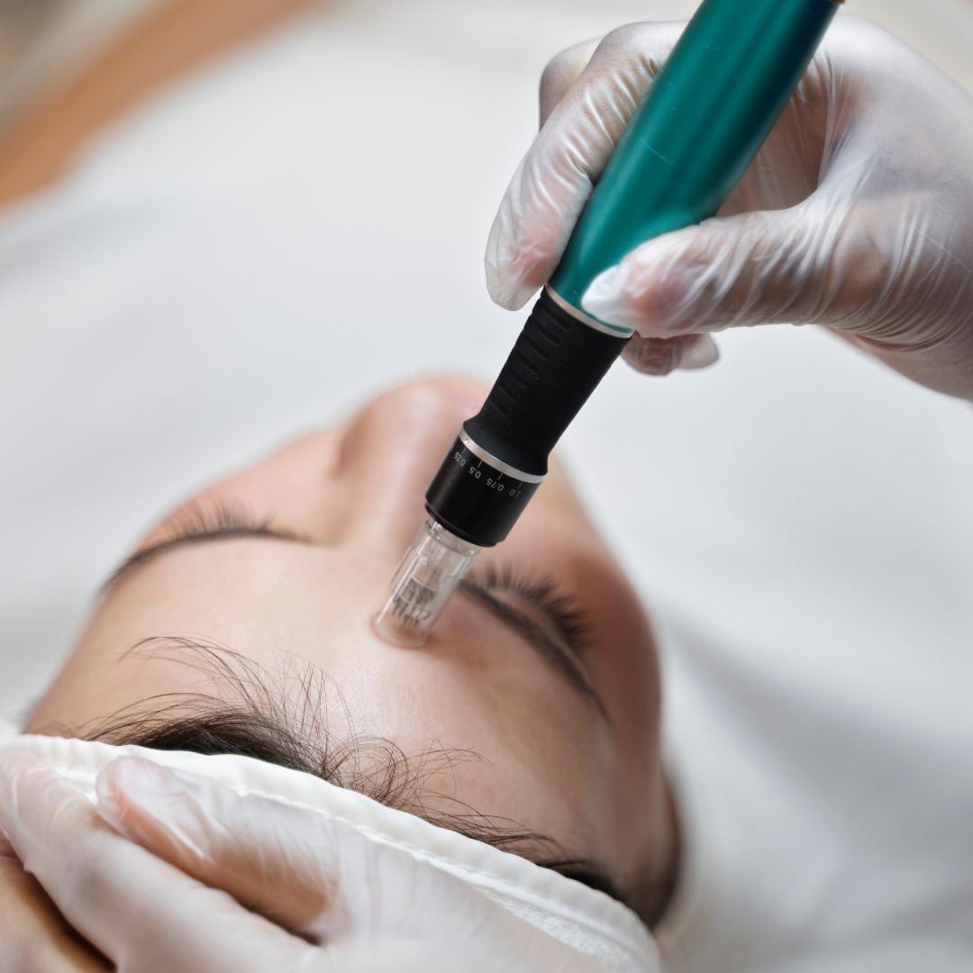 Procedure Of Microneedling