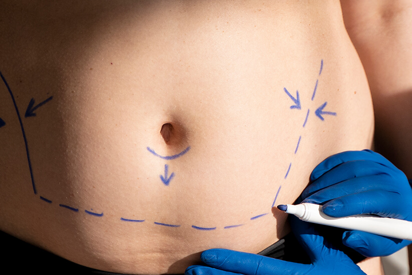 CoolSculpting near me