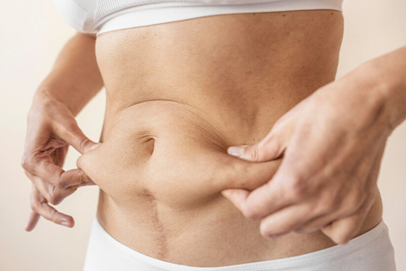 cryolipolysis treatment